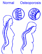 Osteoporosis - loss of calcium in bone leading to fractures.