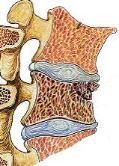 Osteoporotic bone with wedge fracture.